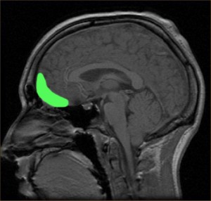 https://commons.wikimedia.org/wiki/File:MRI_of_orbitofrontal_cortex.jpg