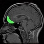 https://commons.wikimedia.org/wiki/File:MRI_of_orbitofrontal_cortex.jpg